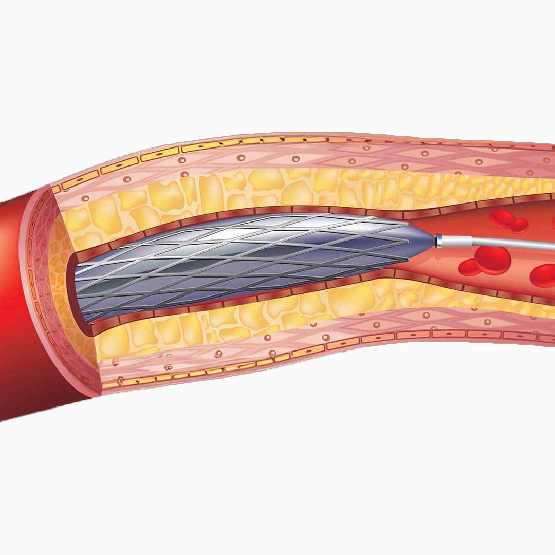Angioplastía Stent - Remodelación de arteria Angioplastía Stent - Remodelación de arteria
