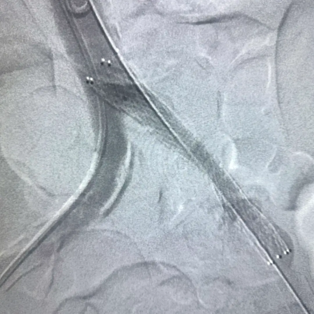 Angioplastía Stent (remodelación de arteria)