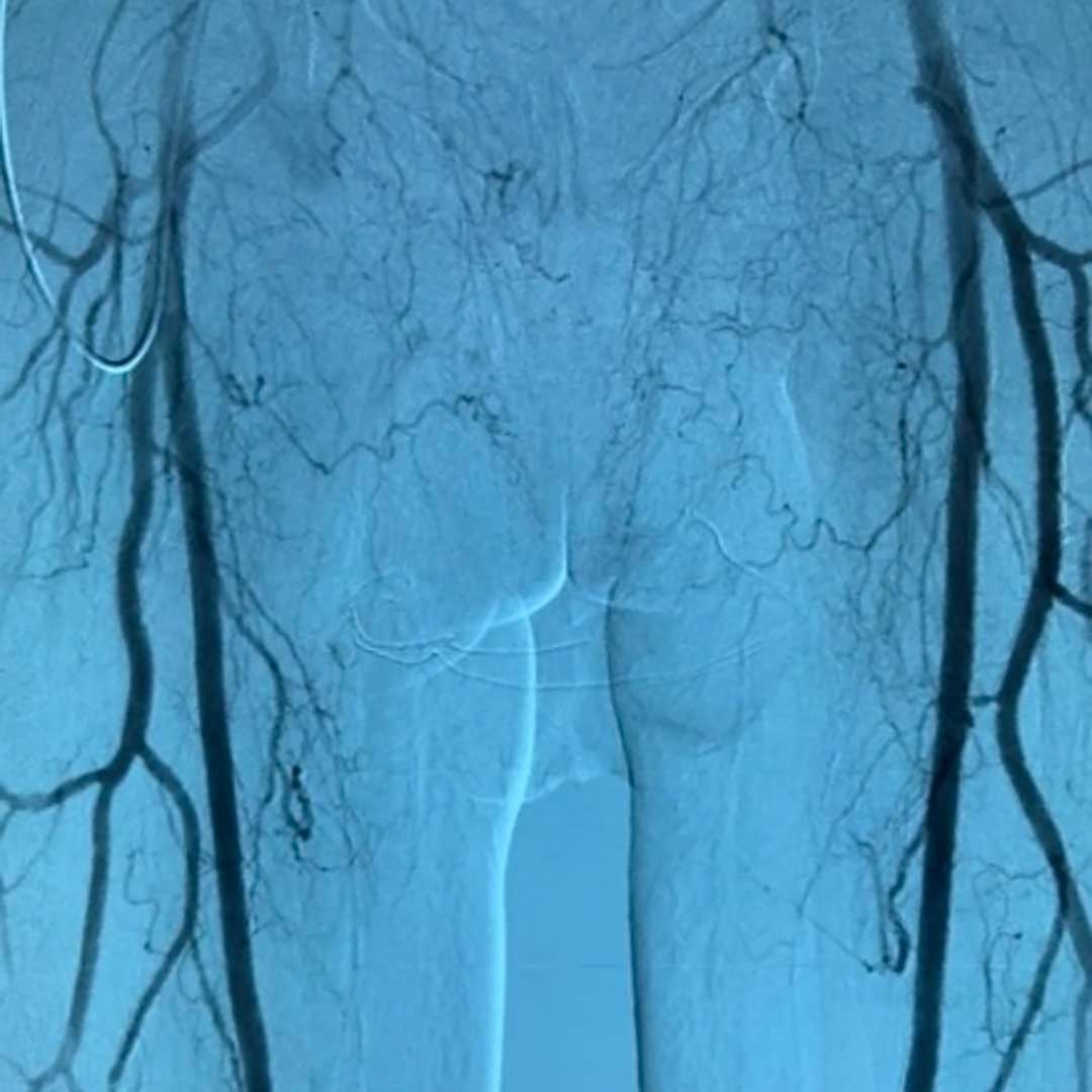 Arteriografía en Intervencenter Arteriografía