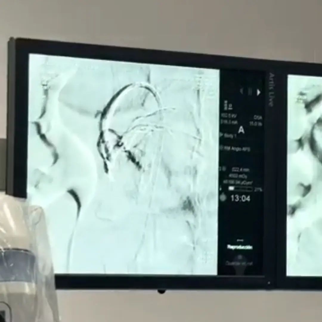 Embolización de miomas uterinos en Intervencenterlab