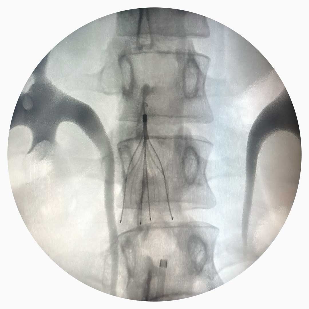 Filtro de Vena Cava Inferior Filtro de Vena Cava Inferior